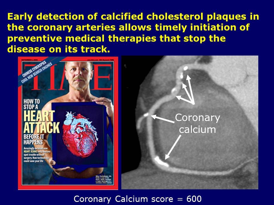 Coronary Calcium Score