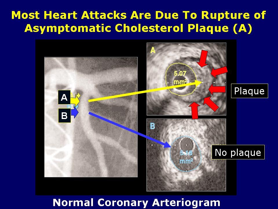 IVUS vs Arteriogram