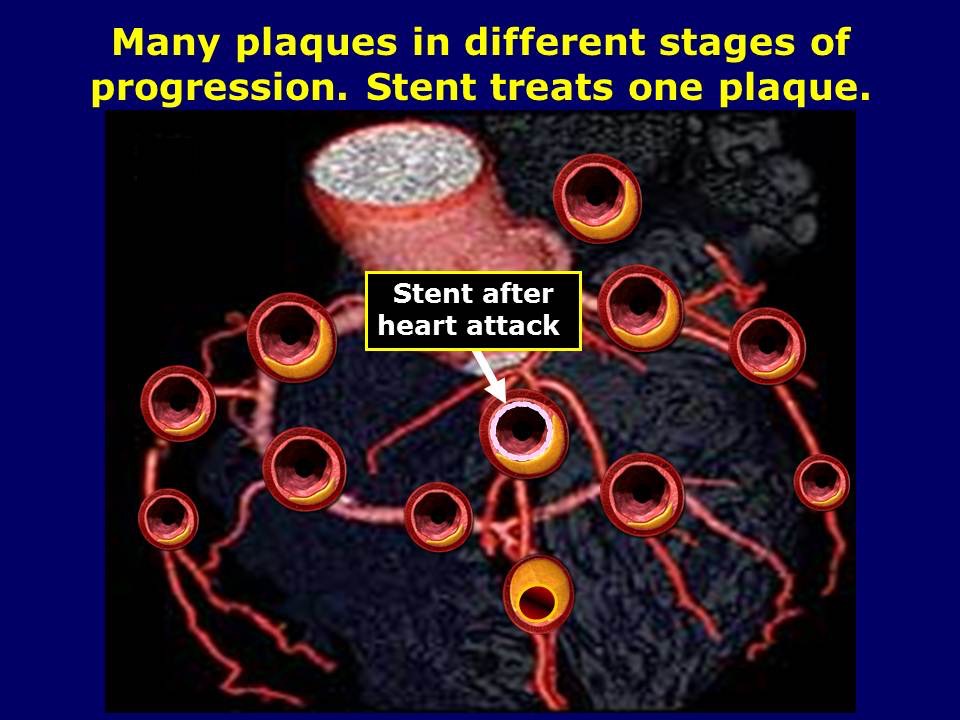Stent Treats One Plaque Advanced Cholesterol Clinic RdeGoma