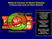 Natural Course of Heart Disease